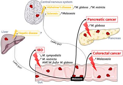 Overview of the Potential Role of Malassezia in Gut Health and Disease